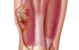 Sarcoma