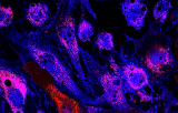 ETV6 probe for FISH CE/IVD - Myelodysplastic syndromes (MDS)