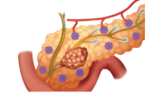 Pancreatic cancer