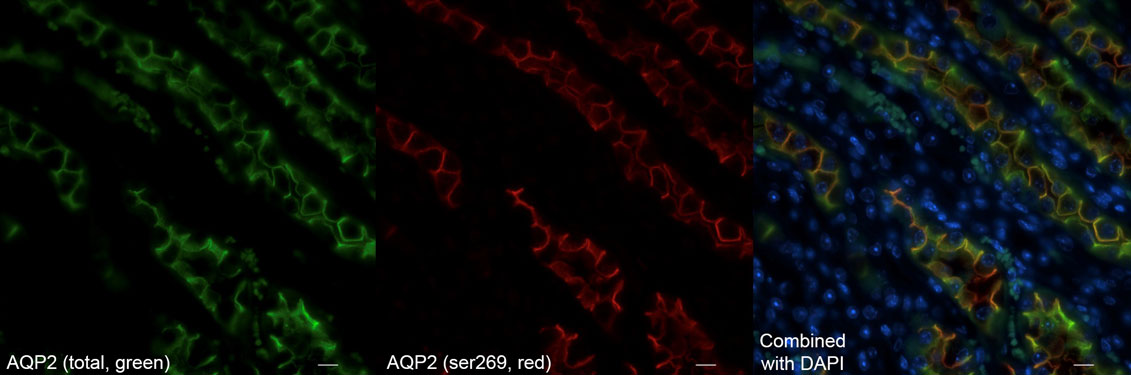 Immunolabeling of vasopressin treated mouse kidney (inner medulla) showing specific labeling of the AQP2 protein phosphorylated at Ser269 (Cat. No. p112-269, red, 1:1000) and total AQP2 (green). Nuclei labeled with DAPI. Magnification 600x.  Image kindly provided by Juan Pablo Arroyo Ornelas, Vanderbilt University.