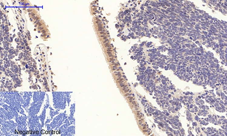 Fig.1. Immunohistochemical analysis of paraffin-embedded human lung cancer tissue. 1, Stat3 (phospho Tyr705) Polyclonal Antibody was diluted at 1:200 (4°C, overnight). 2, Sodium citrate pH 6.0 was used for antibody retrieval (>98°C, 20min). 3, secondary antibody was diluted at 1:200 (room temperature, 30min). Negative control was used by secondary antibody only.