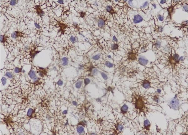 Asterocytoma-grade-II-40x