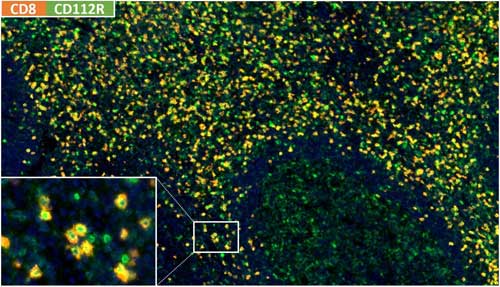 Fig.01 CD112RxCD8 multiplex IHC