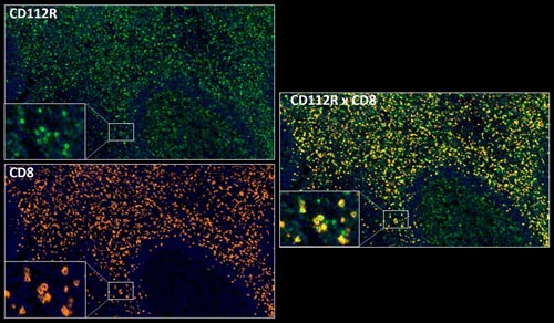 Fig.02 CD112R+CD8 multiplex IHC