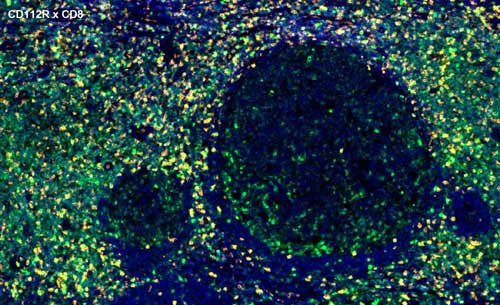 Fig.10 CD112R+CD8 multiplex IHC