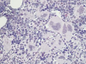 Immunohistochemical staining (IHC) with anti-mutated CALR Antibody (clone CAL2) - dianova