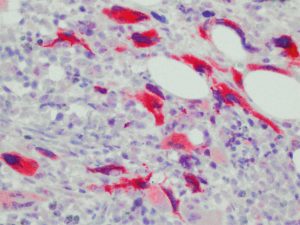 Selective staining of mutated CALR protein in megakaryocytes of a PMF case, in fibrotic phase in which Sanger sequencing detected a CALR mutation.