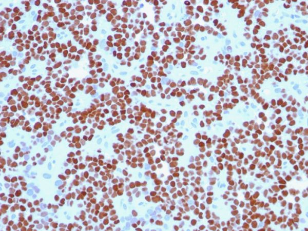 Formalin-fixed, paraffin-embedded human Ewing&apos;s Sarcoma stained with NKX2.2 Mouse Monoclonal Antibody (NX2/294).