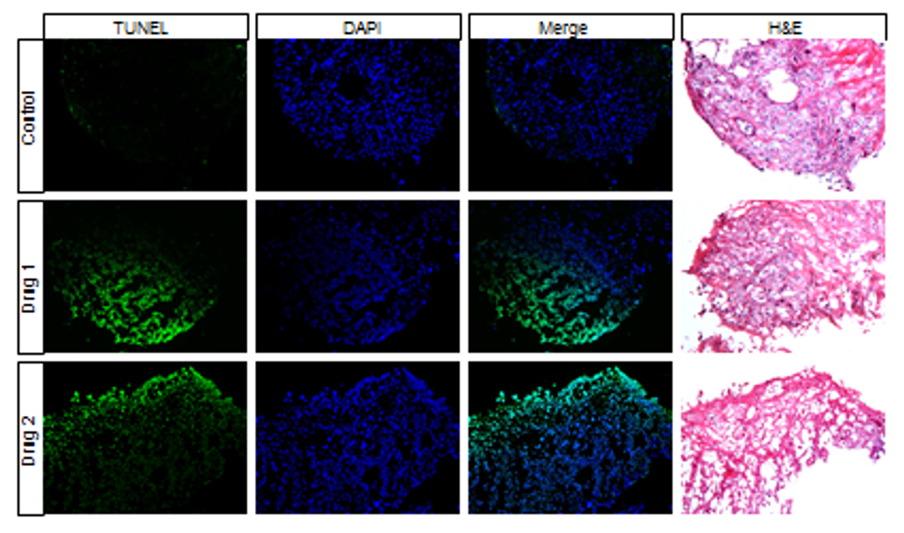 patient derived xenografts